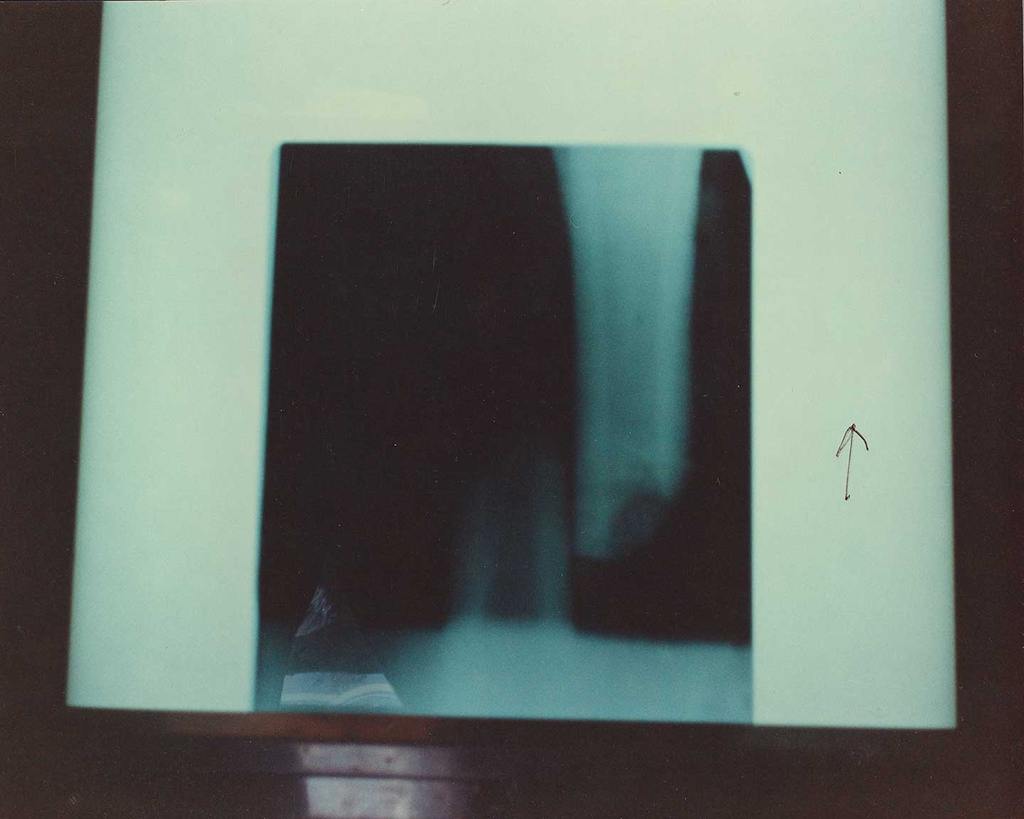 X ray photo of Alydar's leg